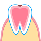 エナメル質の虫歯のイラスト