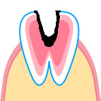 神経に達した虫歯のイラスト