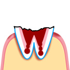 歯根に達した虫歯のイラスト