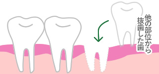 歯の移植・再植の写真・イラスト