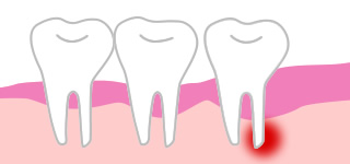 歯根端切除術＋嚢胞摘出術の写真・イラスト