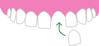 外傷（歯の脱臼、破折、嵌入など）の写真・イラスト